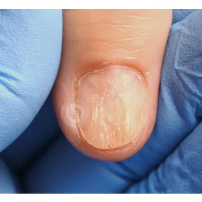 Бороздки на ногтях: продольные / вертикальные / поперечные | Причины |  Лечение борозд на руках / ногах в Москве в Клинике подологии Полёт