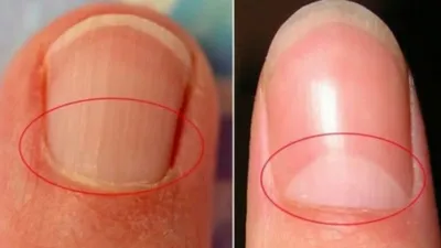 Причины появления черных полос на ногтях | ButterFly | Дзен