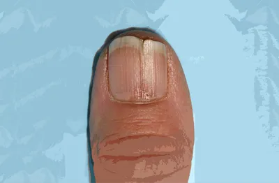 Псориаз ногтей: причины, симптомы, как проявляется, что делать, лечение