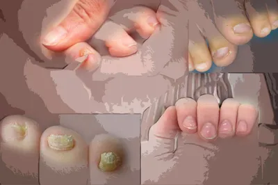 Черные полоски на ногтях рук - причины и лечение