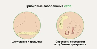 Вросший ноготь. Лечение. Харьков - Центр европейской дерматологии