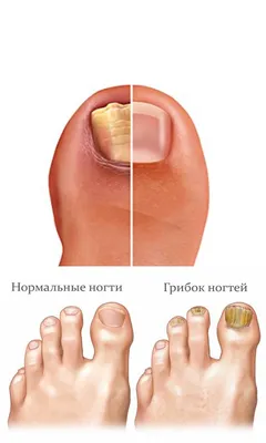 Лечебная косметика+ Ногтивит от грибка ногтей