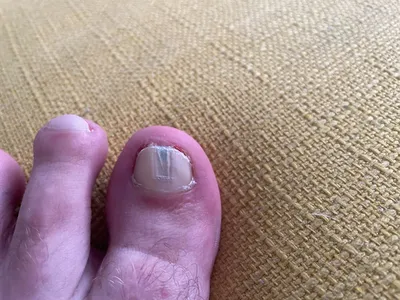 Черные полоски на ногтях: опасны или нет, надо ли лечить и чем это делать -  Beauty HUB