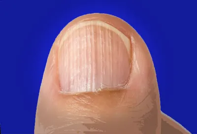 Грибок ногтей Уход за кожей рук для лечения ног антибактериальное удаление  инфекции паронихия онихомикоз Утолщение Мягкий гель | AliExpress