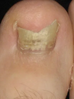 Eelhoe Средство от грибка fungal nail renewal для ногтей 30 мл