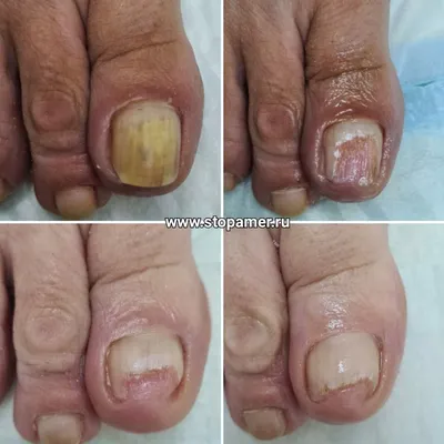 Лазерное лечение грибка ногтей в Киеве - клиника Diamond Laser