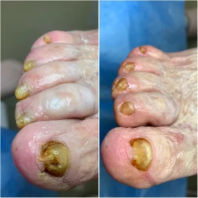 Лечение грибка ногтей на ногах, мед педикюр | Подология Крылатское, Кунцево