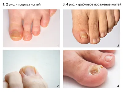 Грибок ногтей у детей: причины и лечение ✓ Клиника подологии Полёт в Москве