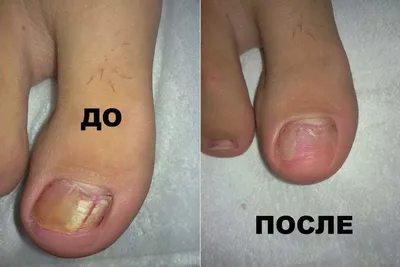 Грибок ногтей: лечение в Москве и Жуковском. Цены на услуги.