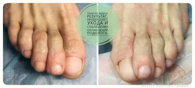 Грибок ногтей после лечения 3 | Лечение ногтей в Санкт-Петербурге