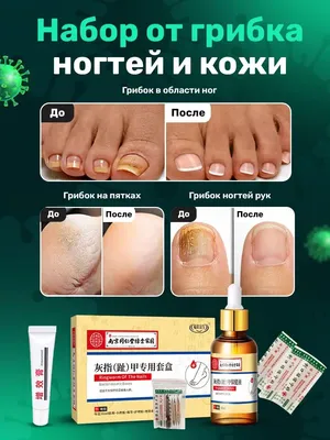 Лечение Грибка ногтей - Микоза / Центр педикюра и подологии на  Рокоссовского 24