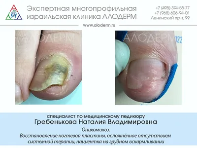 Лечение грибка PACT-MED | Фотодинамическая терапия грибка ногтей в  «СМ-Косметология»