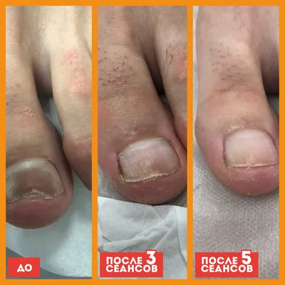 Заражение ногтей на руках после неудачного маникюра | Московская Клиника  Подологии