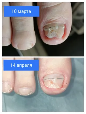 Лечение грибка ногтей - заказать онихомикоз лечение в Киеве и Украине,  выгодная цена на лечение ногтевого грибка в клинике косметологии Медлас