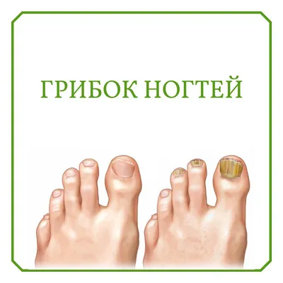 Лечение грибка ногтей в Кирове лазером в клинике Возрождение
