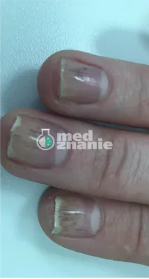 Грибок ногтей. Онихомикоз - эффективное лечение в клинике в Сокольниках