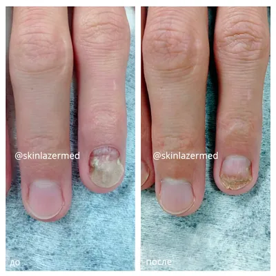 Грибок ногтей: опасность лечения