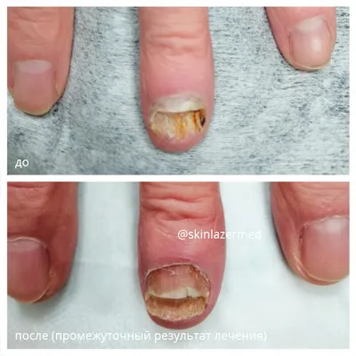 Лечение грибка ногтей | Центр «Dekamedical» в Москве