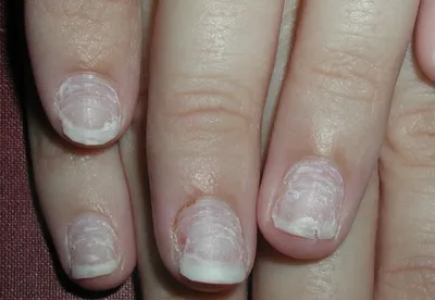 Плесень на ногтях: причины появления и лечение - Рамблер/новости