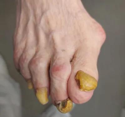 Обработка ногтей от грибка, онихомикоза в Центре подологии СТОПАМЕР