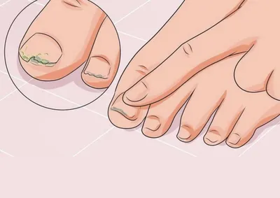 Чем лечить грибок ногтей на ногах в... - Фотоэпиляция ПМР | Facebook