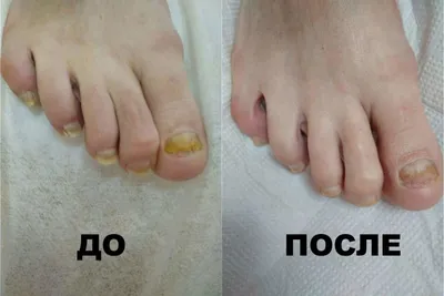 Лечение грибка стопы | Уход от грибка ногтей - Nailyuba
