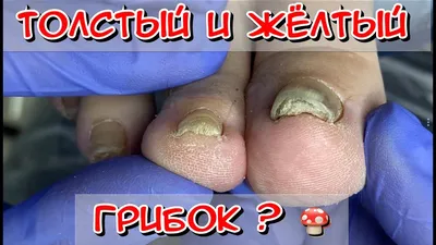 Толстый и Желтый ноготь / Грибок ногтей, что Делать? /Грибок на ногах  /Грибы /Грибок ногтей на ногах - YouTube