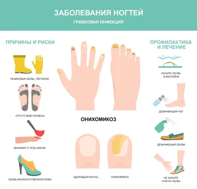 Грибок ногтей (Онихомикоз): причины, симптомы, лечение, профилактика