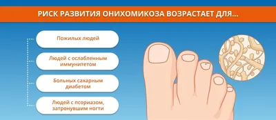 ✔️ Лечение грибка ногтей на ногах - Узнать цену на сайте - podonails.com