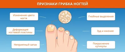 Грибок ногтей на ногах | Лечение онихомикоза под ногтем