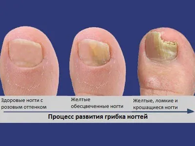 Среди них - противозачаточные гормональные средства. Лечение грибка ногтей  на ногах в домашних условиях может дать положите… | Лечение ногтей, Ногти,  Ногти на ногах
