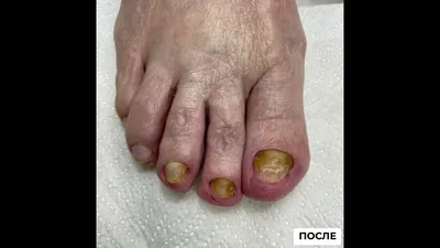 Причины и симптомы грибка ногтей на ногах