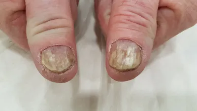 Лечение грибка ногтей лазером без боли, терапия онихомикоза в Киеве