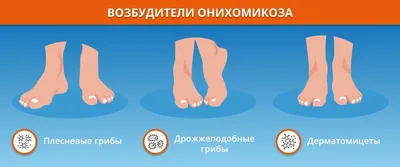 Чем опасен грибок ногтей на ногах? Симптомы и лечение в Киеве