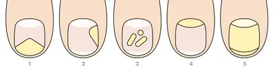 Лечение грибка ногтей в Минске - Linline