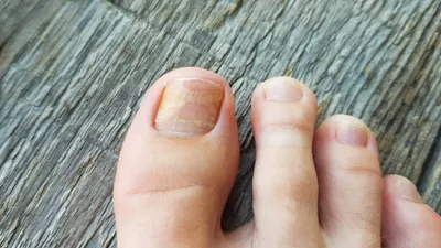 ⭐ Эффективное лечение грибка ногтей на ногах - podonails.com