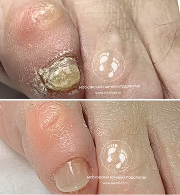 Лечение грибка ногтей лазером в Новосибирске по цене от 1500 руб.