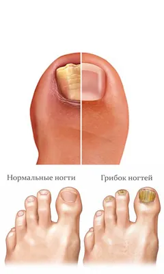 Обработка ногтей от грибка, онихомикоза в Центре подологии СТОПАМЕР