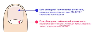 Грибок ногтей (онихомикоз): причины, симптомы и рекомендации по лечению  заболевания. Доктор Питер | DOCTORPITER