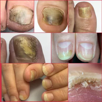 Грибок ногтей (Онихомикоз): причины, симптомы, лечение, профилактика