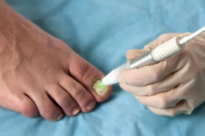 Лечение вросшего ногтя в Самаре цена | Клиники доктора Кравченко