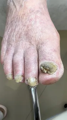 Онихомикоз: почему ногти на руках и ногах поражаются грибком?