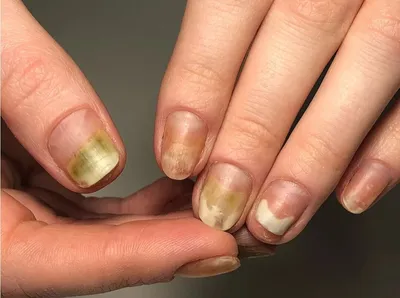 Грибок ногтей после гель лака фото фото