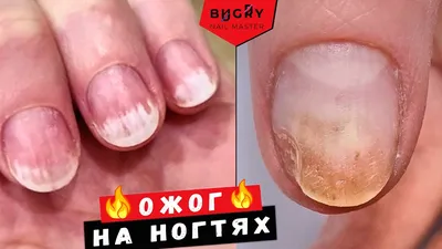 Лазерное лечение грибка ногтей - SkinLazerMed