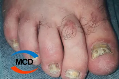 Грибок ногтей ног — Медицинский Центр Дерматологии
