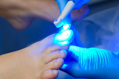 Лечение грибка ногтей - заказать онихомикоз лечение в Киеве и Украине,  выгодная цена на лечение ногтевого грибка в клинике косметологии Медлас