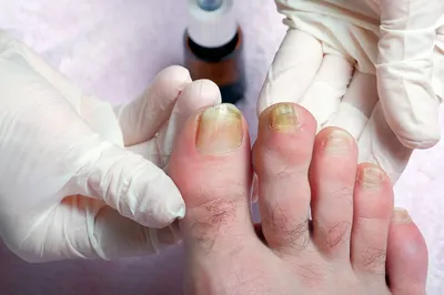 VALGO PODOCARE - Симптомы грибка ногтей.✔️ ⠀ Как правило, грибком  поражаются ногтевые пластины стоп, гораздо реже – кистей. Основными  клиническими проявлениями болезни являются: ⠀ 🔸изменения формы и цвета  ногтевой пластины; 🔸деформация ногтя;