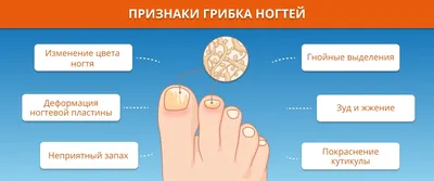 Грибок ногтей или онихомикоз | Описание заболевания - meds.ru