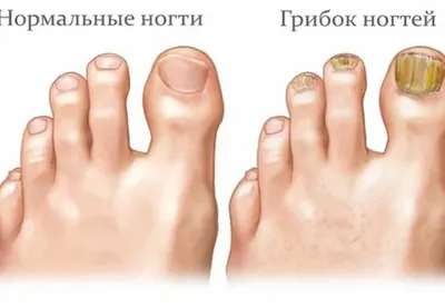 Кандидоз ногтей: лечение, причины, симптомы и диагностика грибка кандида на  ногтях