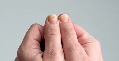 Лечение грибка ногтей в Санкт-Петербурге: профессиональное лечение  онихомикоза в клинике «МедЛайн».